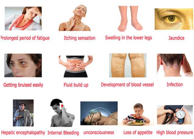 First Signs Of Cirrhosis