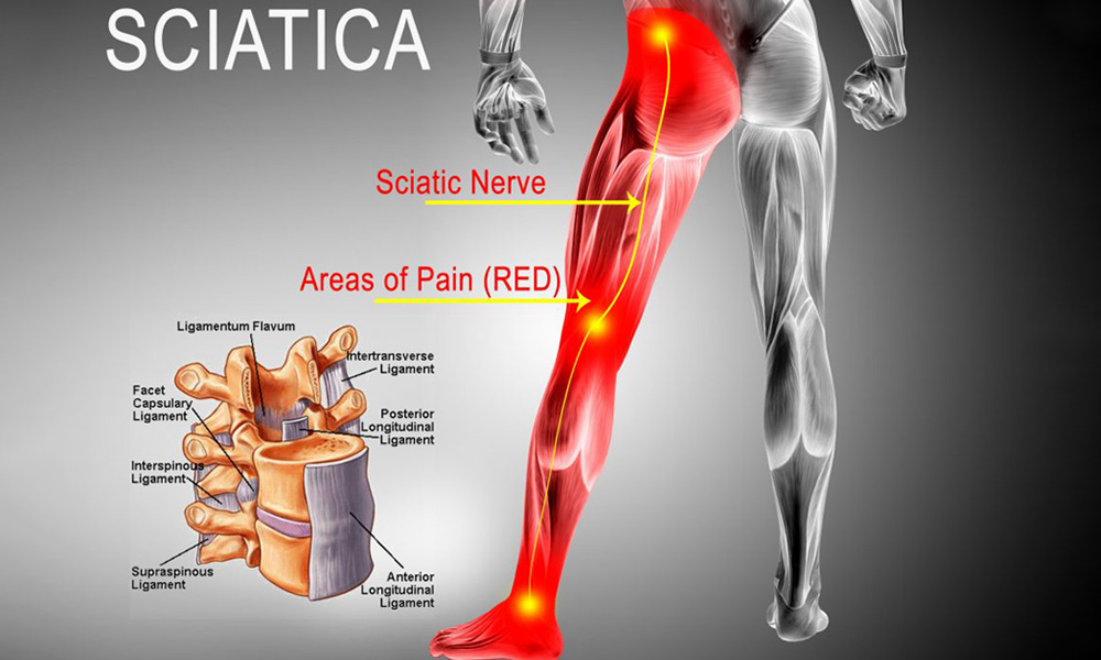 can you get sciatica from a bad mattress