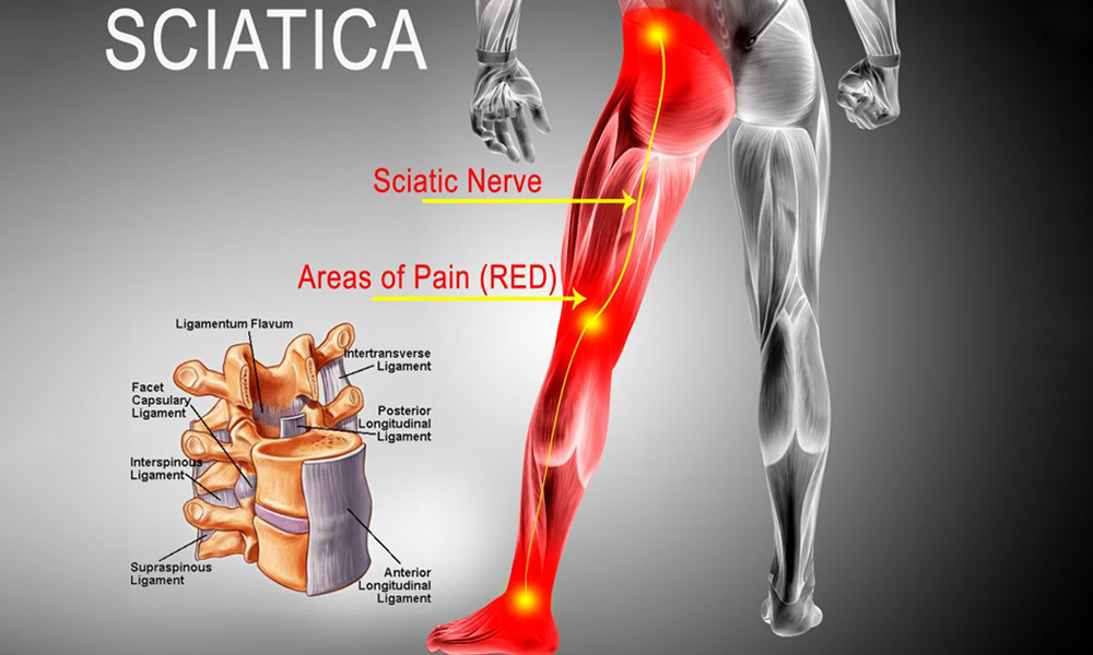 Ayurvedic Treatment For Sciatica Travancore Ayurveda